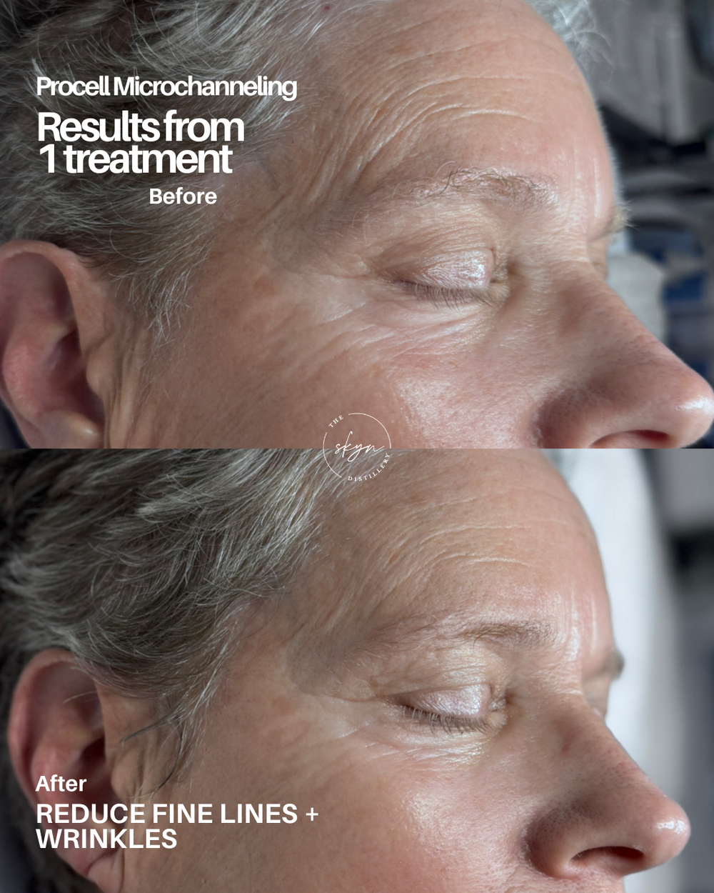 How to Care for Your Skin After Microchanneling (Procell Aftercare Guide)