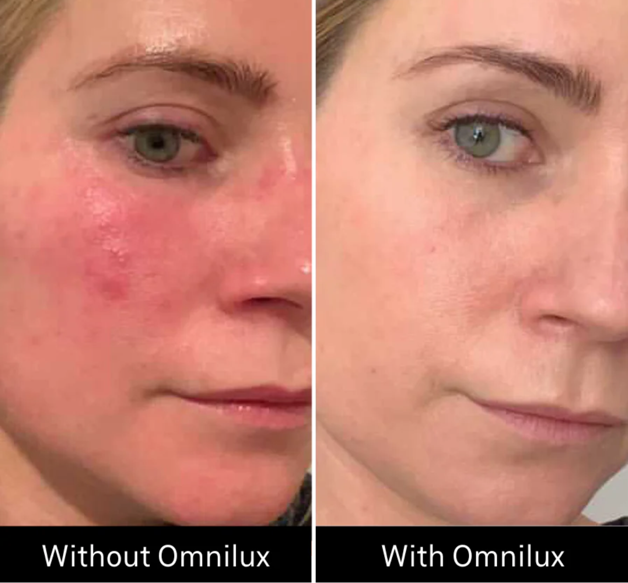Omnilux Contour Face