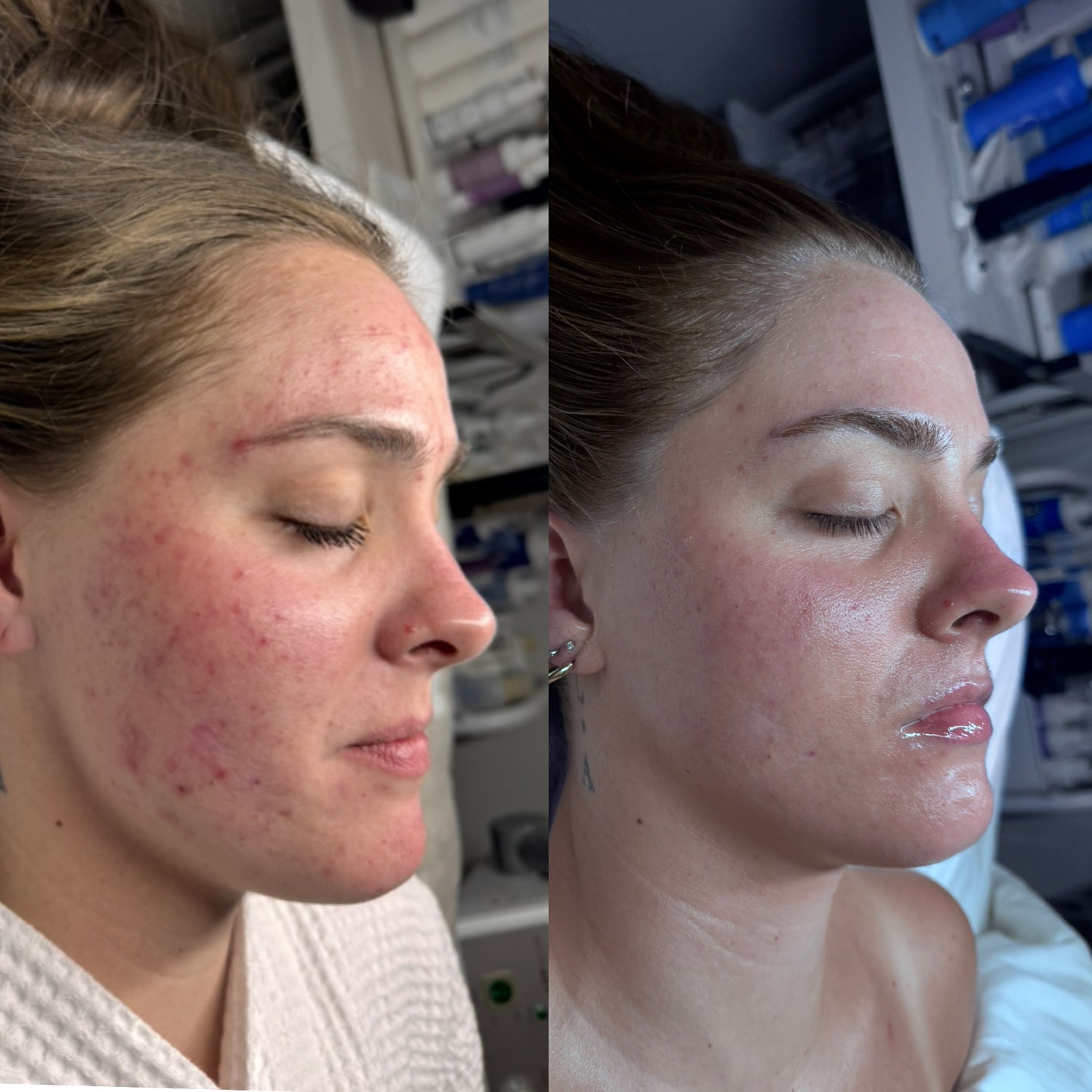 Before and after comparison of a womens acne cleared for wedding day skin in wayzata, mn using face reality clear skin method.