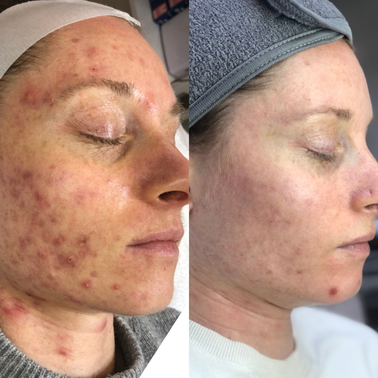 Before and after acne client using the clear skin method at the skyn distillery in wayzata mn