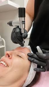 Natural botox alternative to stimulate collagen and elastin in skin by doing a series of procell microchanneling in wayzata, mn at the Skyn Distillery